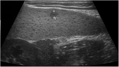 Case report: Aseptic splenic abscesses in childhood-onset systemic lupus erythematosus